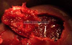 Urinary Tract Infection From Severe Pus Clots : Fatality Compilation